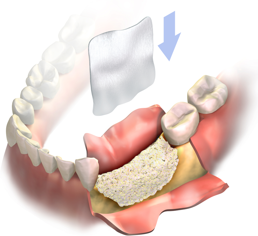 Bone Grafting Indy Oral Surgery
